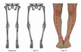 Check spelling or type a new query. Penyebab Kaki O Atau Bowlegs Dan Treatment Yang Tepat