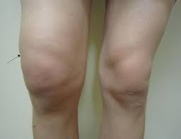 It doesn't typically require a it can deform and debilitate the joints over time. Intermittent Hydrarthrosis Wikipedia