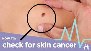 While melanoma isn't the most common type of skin cancer, it's the most serious. How To Check For Skin Cancer Youtube