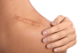 Then, gently wipe or dab the skin around the wound. Researchers Find Drug That Enables Healing Without Scarring News Center Stanford Medicine