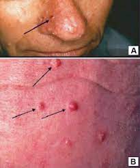 Muir Torre Syndrome Mts An Update And Approach To Diagnosis And Management Journal Of The American Academy Of Dermatology