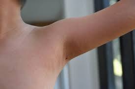 Gli adulti non ne sono immuni e possono ammalarsi se entrano in contatto con qualcuno affetto da questo batterio. Scarlattina Amico Pediatra