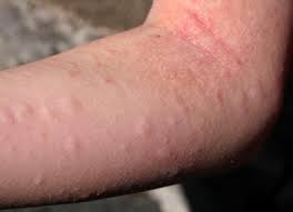 Newinfo Allergies To Dogs Rash