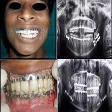 PDF) Secondary correction of the post-traumatic deformity: A clinical study