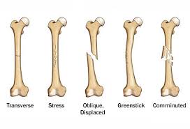 Slideshow Broken Bones And How They Heal Bone Fracture Broken Bone Types Of Fractures