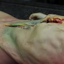 A new orphan product used for the prevention and treatment of purpura fulminans in meningococcemia is being developed by immuno clinical research corp. Fatal Meningococcal Meningitis In A 2 Year Old Child A Case Report