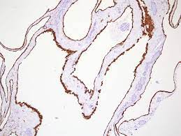 2departament of pathology and forensic medicine, federal university of bahia,. Case Of The Week 205