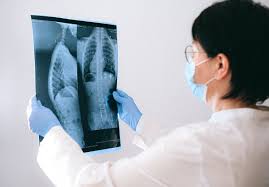 Some lung cancers can cause syndromes, which are groups of very specific symptoms. 10 Signs You May Have Lung Cancer Rediff Com Get Ahead