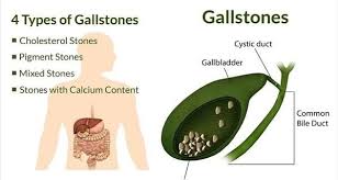 4 Foods That Can Painfully Dissolve Gallstones And Kidney Stones Faster Than Any Medication Gallstones Gallbladder Stones Gallbladder