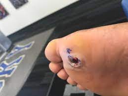 This article looks closely at the types of foot melanoma and explains how to recognize the symptoms. What Does Foot Melanoma Look Like Skin Cancer Can Hide As Spot On Sole