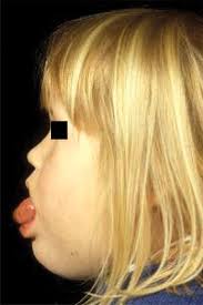 Radiofrequency ablation in the treatment of paediatric microcystic  lymphatic malformations