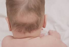 Image result for sores on the head in children