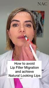 Migration happens when filler is placed too close to or beyond the  vermilion border, or when product is injected into the wet mucosa instead  of the dry mucosa. Staying in the correct plane and ...