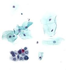 It offers clear recommendations on how australia can reduce the burden of cancer disease and death. Pap Test Wikipedia
