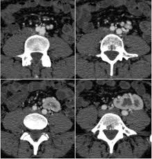 28 Year Old Woman With Duplex Collecting System In A Pelvic Kidney Download Scientific Diagram
