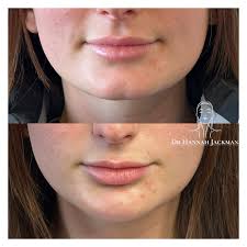 CHIN FILLER This patient didn't like the dimple in her chin so we added a  tiny amount of filler to disguise the appearance of this. From the front  view, the lower face