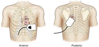Defibrillation is a process in which an electrical device called a defibrillator sends an electric shock to the heart to stop an arrhythmia resulting in the return of a productive heart rhythm. Electrical Therapy Thoracic Key