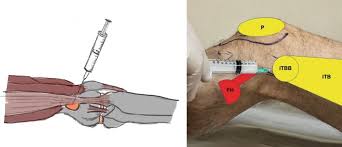 Image result for Prepatellar Bursa Injection