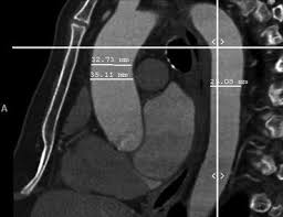 These factors substantially increase the diagnostic accuracy of the examination. Cardiac Multislice Ct Springerlink