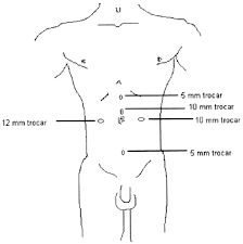 Drink at least 6 to 8 glasses of water each day. Laparoscopic Ileal Conduit Five Year Follow Up Urology