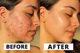 Micro Tretinoin Gel: Elevate Your Skincare Game With Retin-A Micro