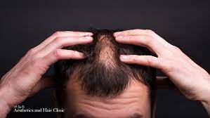 Hair loss or thinning of the hair increased appetite increased volume of pale, dilute urine irritability lack of feeling or emotion loose stools loss of memory muscle tension, tightness, or weakness problems with memory restlessness severe and throbbing headache shakiness and unsteady walk sneezing tenderness in the stomach area Atenolol Side Effects Hair Loss
