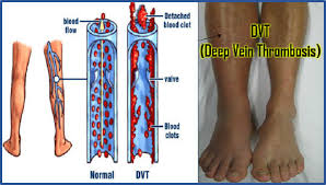 La trombosis venosa profunda (tvp) es una afección que ocurre cuando se forma un coágulo de sangre en una vena profunda. Trombosis Clinica Britannia