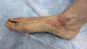 Image result for Lichen Simplex Chronicus