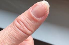 Na osušeni crveni (ili crni) gel lak stavimo metalik gel (radimo ombre). Ovako Mi Nokti Izgledaju Nakon 6 Godina Trajnoga Laka Miss7 24sata Hr