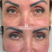 UnderEye Filler