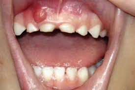 Home remedies may help treat the symptoms, but the abscess will need treatment and drainage from a dentist. 18 Gum Boil Ideas Natural Cures Gum The Cure