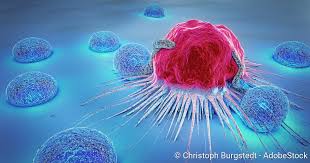 Knochenkrebs Osteosarkom Symptome Therapie Prognose Netdoktor