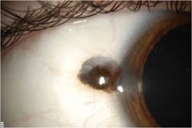 Image result for conjunctival melanoma