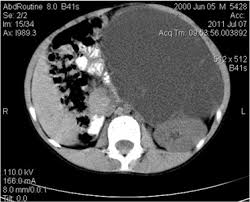 Peritoneal mesothelioma is a rare abdominal disease; Benign Cystic Mesothelioma Of The Peritoneum In A Male Child Journal Of Pediatric Surgery