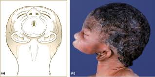 Image result for Micrognathia