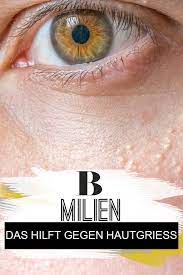 das kannst du gegen den hautgriess tun milien haut milien auge