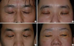 Image result for xanthelasma of eyelid