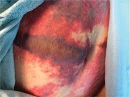 Purpura fulminans and adrenal hemorrhage due to group y meningococcemia in an elderly woman. Pneumococcal Sepsis Induced Purpura Fulminans In An Asplenic Adult Patient Without Disseminated Intravascular Coagulation The American Journal Of The Medical Sciences