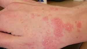 There are two types of herpes simplex virus (hsv) that cause a skin rash in different areas Skin Infection Pictures And Treatments