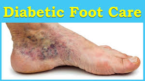 We did not find results for: 230 Diabetic Neuropathy Ideas In 2021 Neuropathy Diabetic Neuropathy Neuropathy Treatment