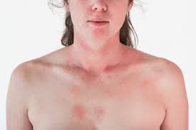 5 causes of hives you wouldn t expect in 2021 hives causes hives itching skin