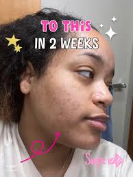 Best Korean Skincare for Acne Scars: Reddit Users' Top Picks and Tips