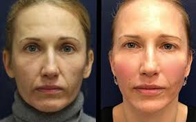 We did not find results for: Thread Lift In Hull Beautiful Beings