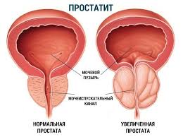 Ostryj I Hronicheskij Prostatit Priznaki Simptomy I Lechenie