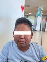 Lucio Phenomenon pada Penyakit Hansen: Sebuah Kasus yang Terabaikan