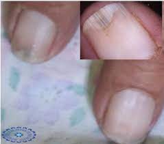 Systemic connective tissue diseases • definition • classification • mechanisms • selected systemic connective tissue diseases. Nail Disorders In Patients With Chronic Renal Failure