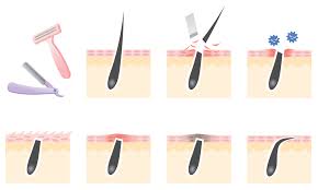 These methods can lead to ingrown hairs and infections though, so most gynecologists warn against them and recommend trimming or letting it be instead. How To Prevent Ingrown Hairs Brazillian Waxing Norwich
