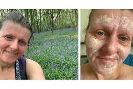 Topical steroid withdrawal and skincare