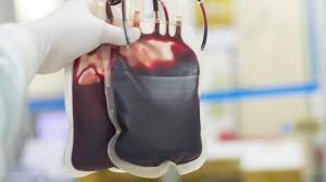 Pada bayi à perdarahan >10% tbv àtransfusi. Kenali Penyakit Thalasemia Gejala Dan Pengobatannya Selain Transfusi Darah Health Liputan6 Com