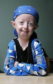 Image result for progeria case in bihar